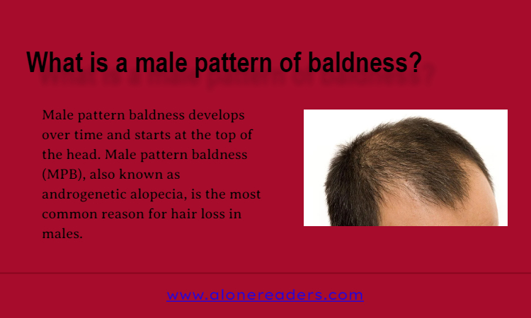 What is a Male Pattern of Baldness?