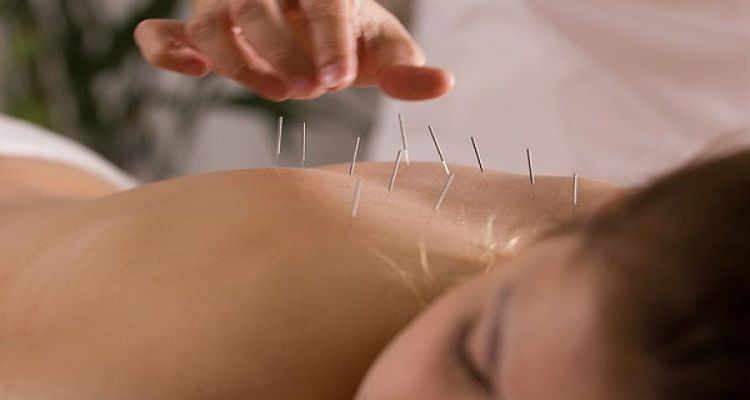 6 Surprising Benefits of Acupuncture