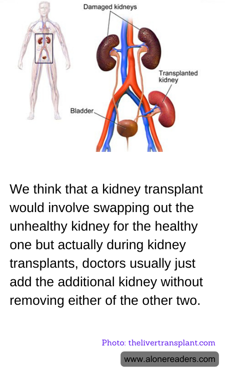 We think that a kidney transplant would involve swapping out the unhealthy kidney for the healthy one but actually during kidney transplants, doctors usually just add the additional kidney without removing either of the other two.