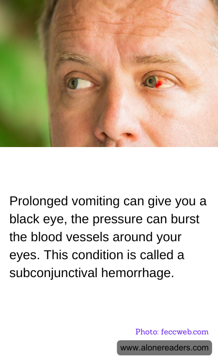 Prolonged vomiting can give you a black eye, the pressure can burst the blood vessels around your eyes. This condition is called a subconjunctival hemorrhage.