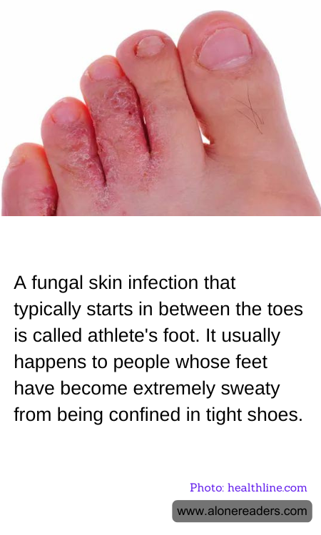 A fungal skin infection that typically starts in between the toes is called athlete's foot. It usually happens to people whose feet have become extremely sweaty from being confined in tight shoes.