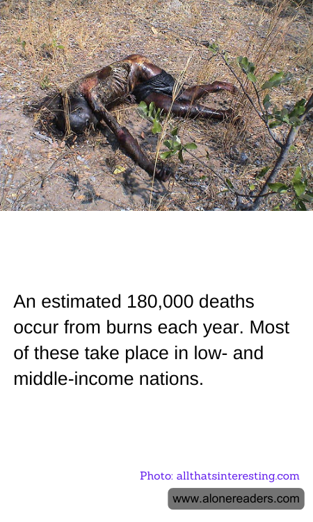 An estimated 180,000 deaths occur from burns each year. Most of these take place in low- and middle-income nations.